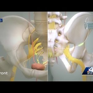 For Your Health: Bladder pacemaker eases urinary problems